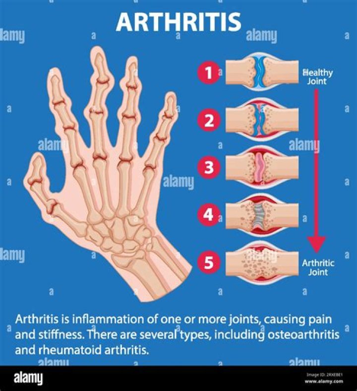 At what age does arthritis usually start?