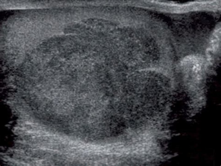 Can a tumor be missed on ultrasound?