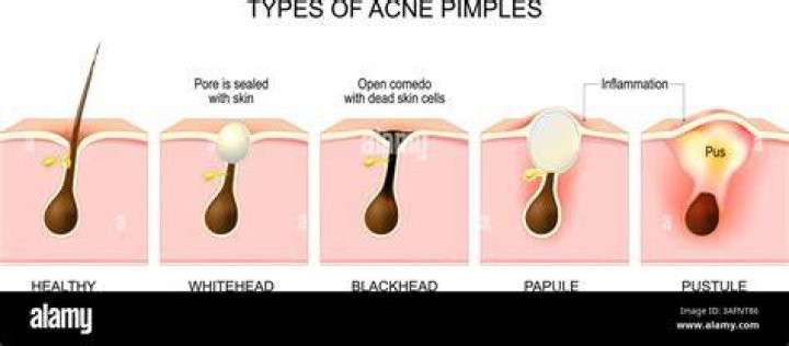Do blind pimples have pus?