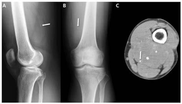 Does sarcoma show up in bloodwork?