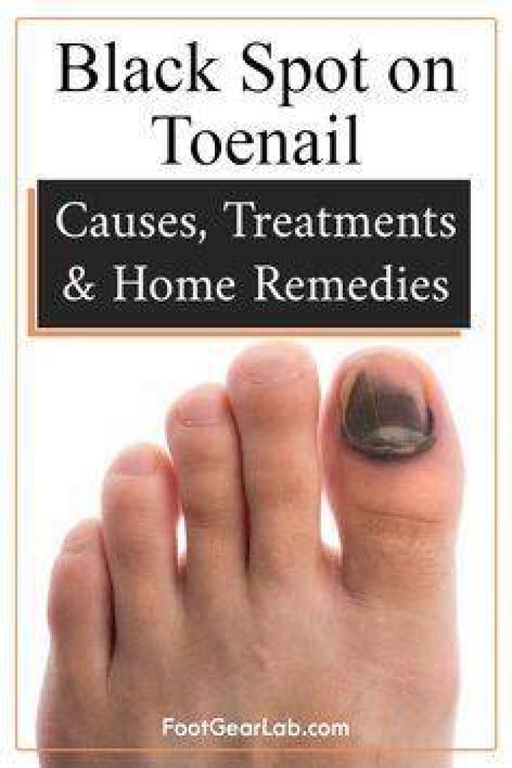 How do you get rid of thick black toenails?