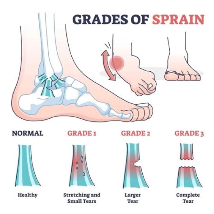 How painful is a grade 3 ankle sprain?