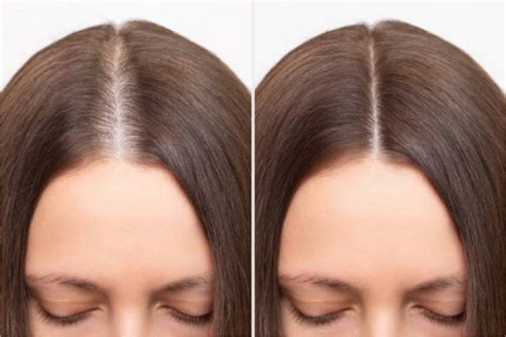 Is hair thinning permanent?