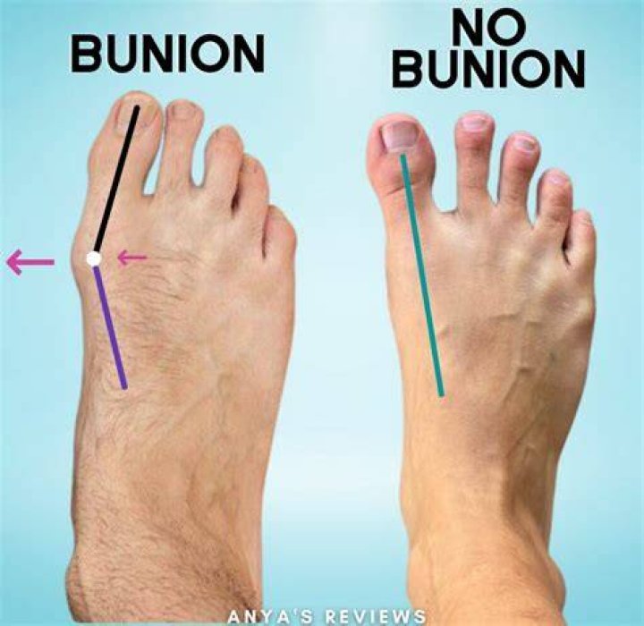 What happens if you don't fix your bunion?
