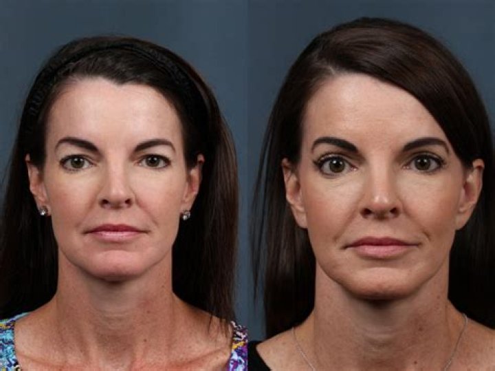 What is the best age to have a facelift?