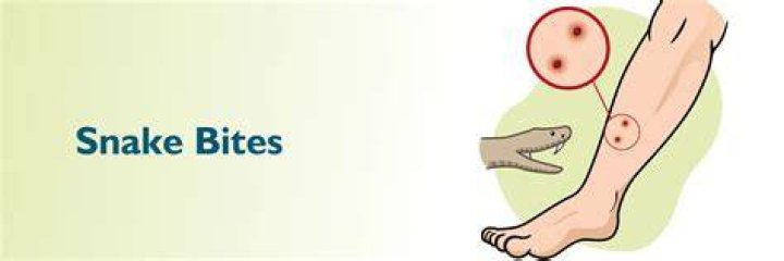 Why don't you put ice on a snake bite?