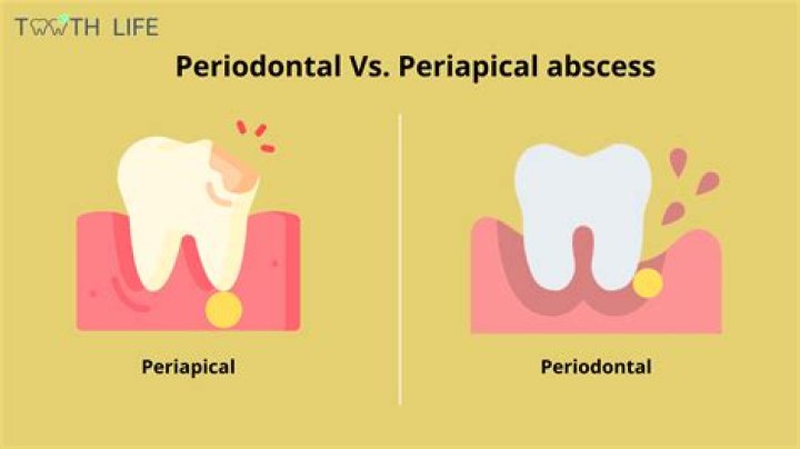 Why is there no cure for periodontitis?
