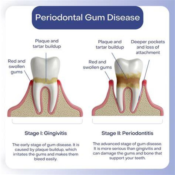 Why periodontitis is painless?